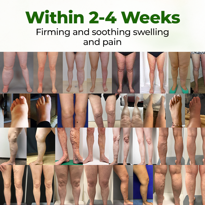 Glowrizon® Circulation Boost Cream – Clinically proven relief for swollen, heavy, painful legs.