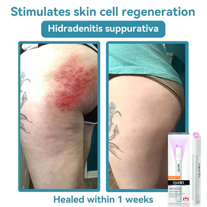 QIAWI™ All-in-One CO₂ Laser Eraser Pen | Removes Moles, Warts, Skin Flaws & Pigmentation